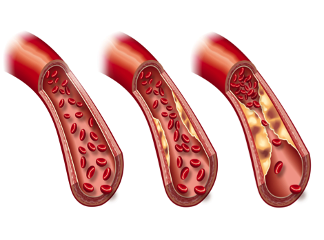 Die drei Phasen der Arteriosklerose