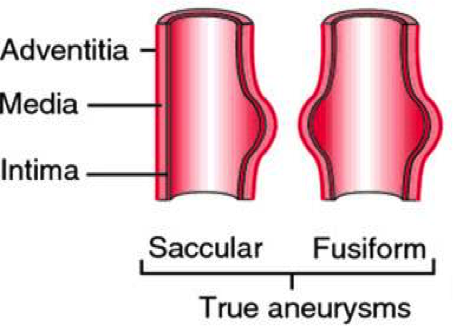 Aneurysma.png